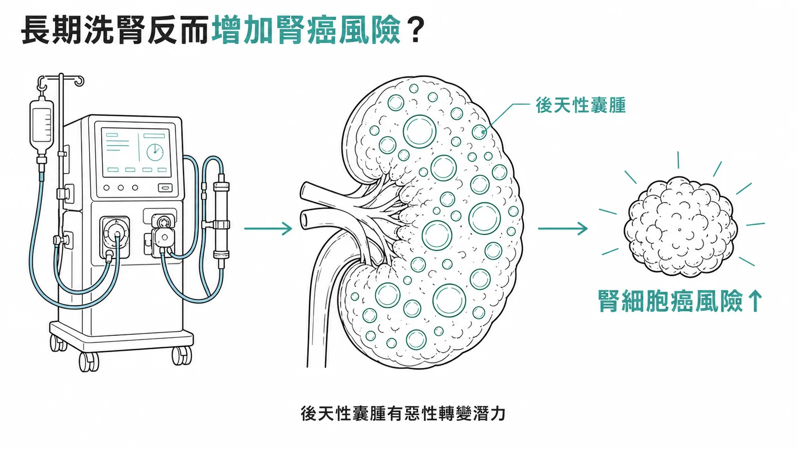 長期洗腎導致後天性囊腫腎病，反而增加腎細胞癌風險