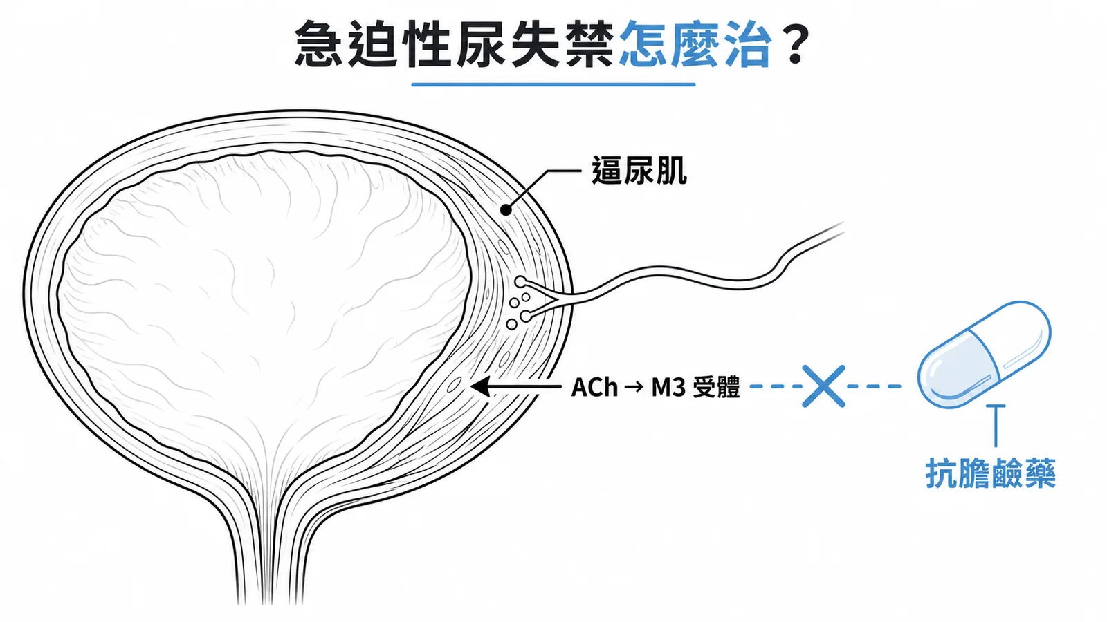 急迫性尿失禁以抗膽鹼藥阻斷 ACh 對 M3 受體的作用來抑制逼尿肌過度收縮