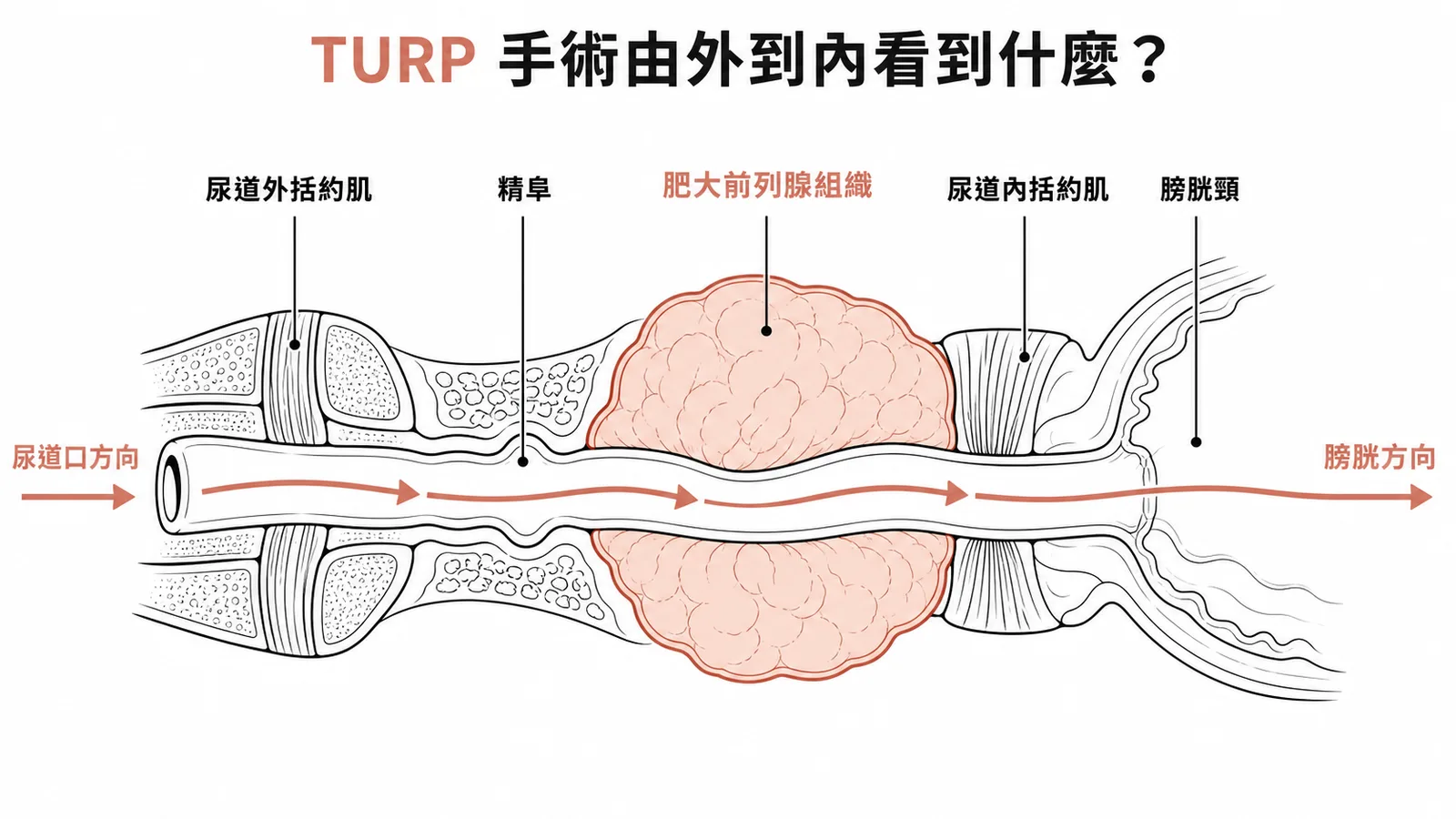 TURP 手術由尿道口進入依序經過外括約肌、精阜、肥大前列腺、內括約肌、膀胱頸