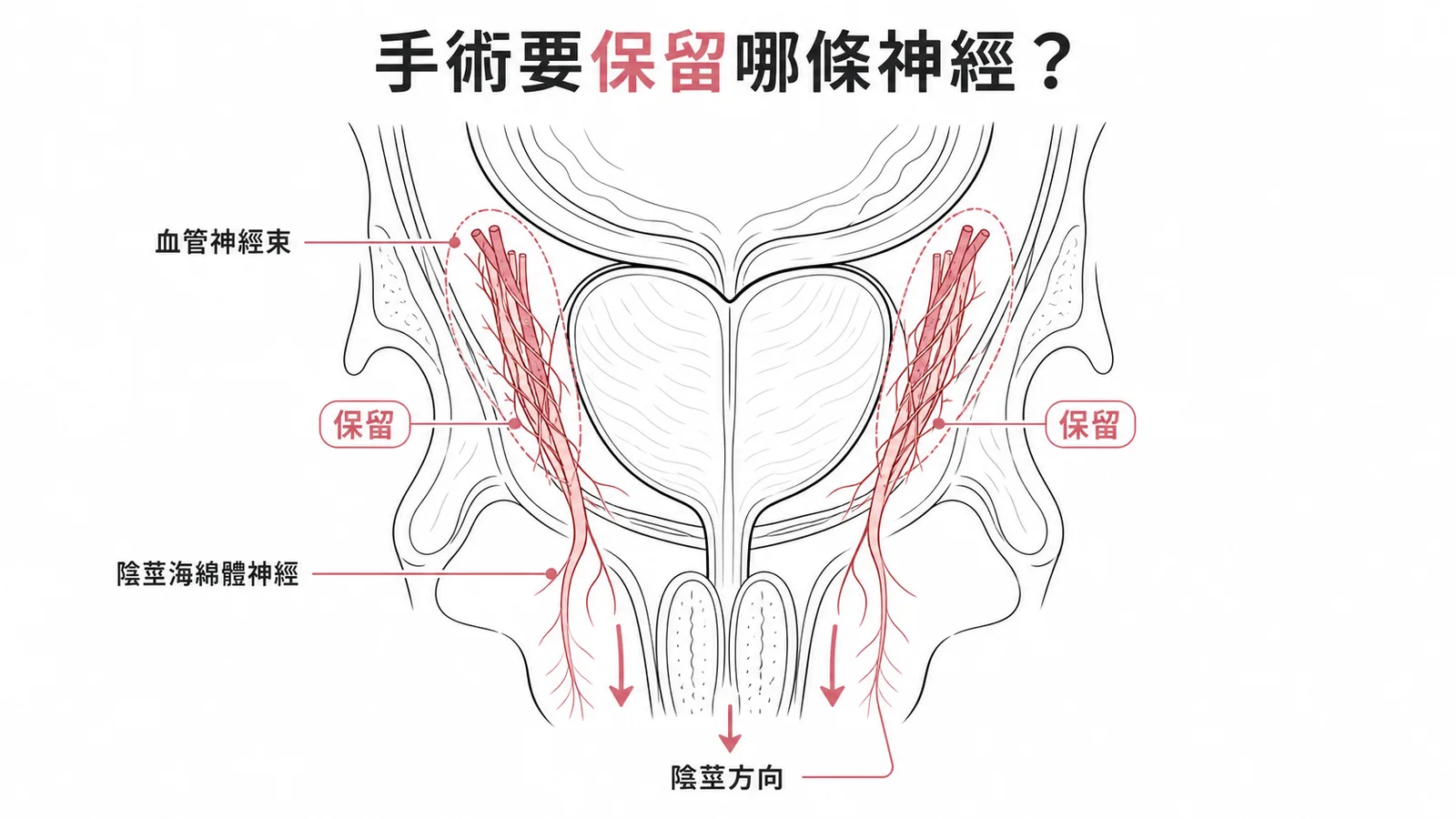 神經保留攝護腺根除手術保留攝護腺兩側血管神經束中的陰莖海綿體神經以維持勃起功能