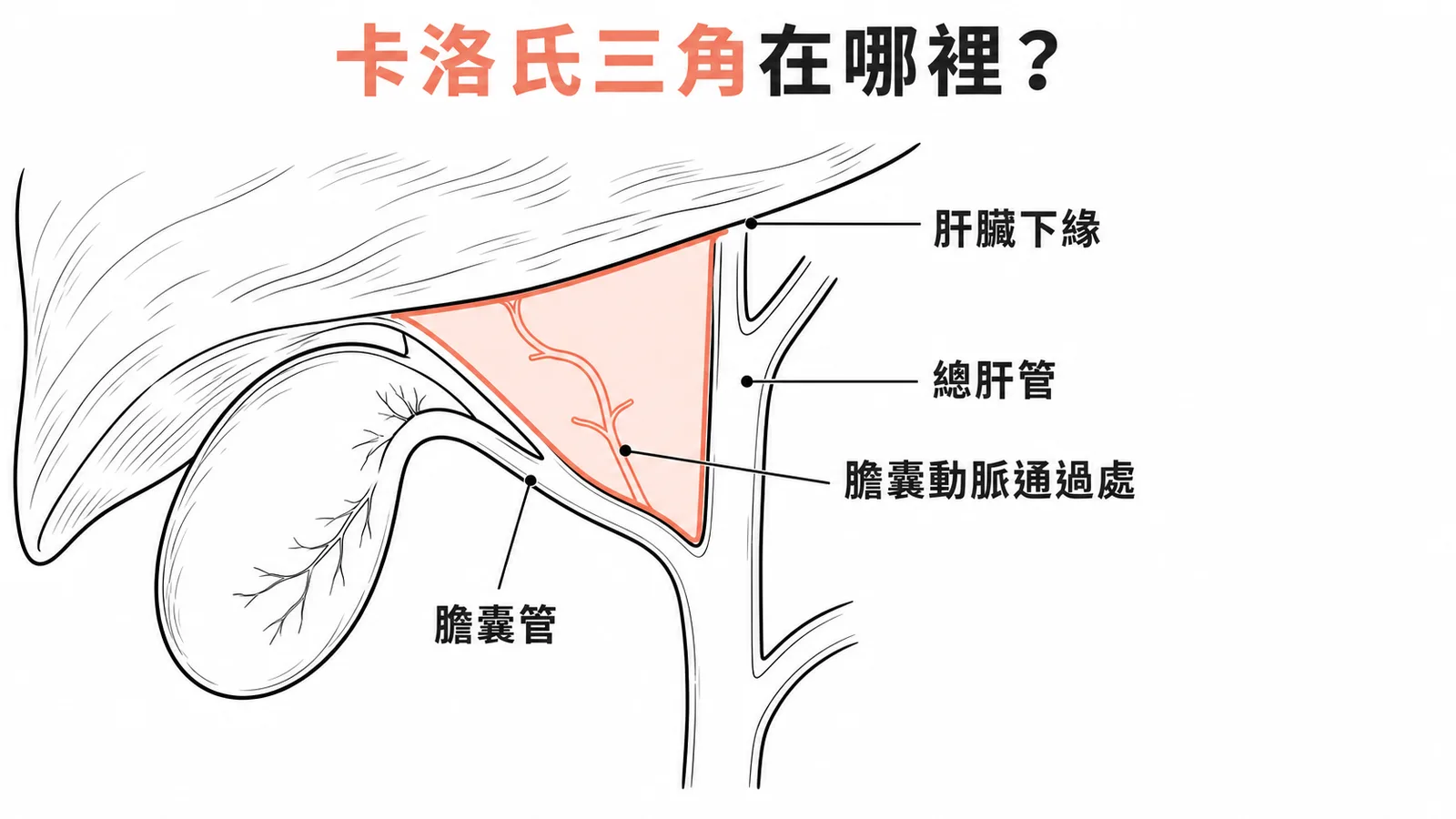 卡洛氏三角解剖位置：總肝管、膽囊管、肝臟下緣圍成的三角區域