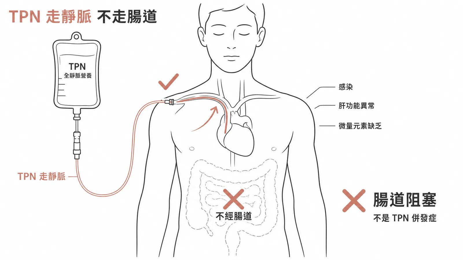 TPN走靜脈不經腸道，腸道阻塞不是TPN併發症
