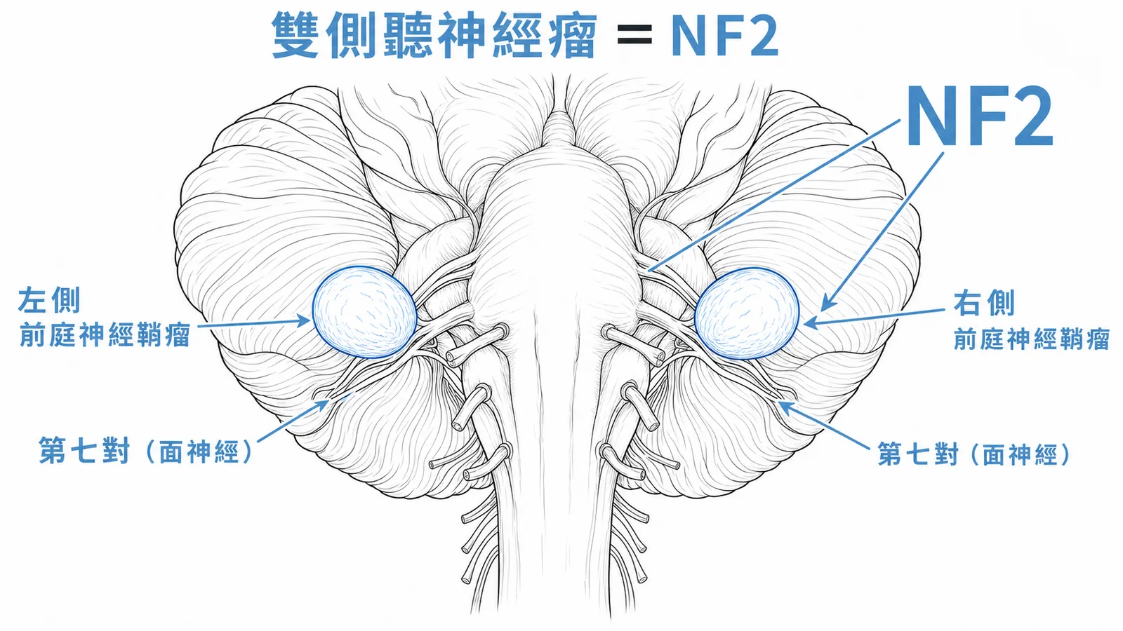 雙側聽神經瘤（前庭神經鞘瘤）是NF2的典型特徵