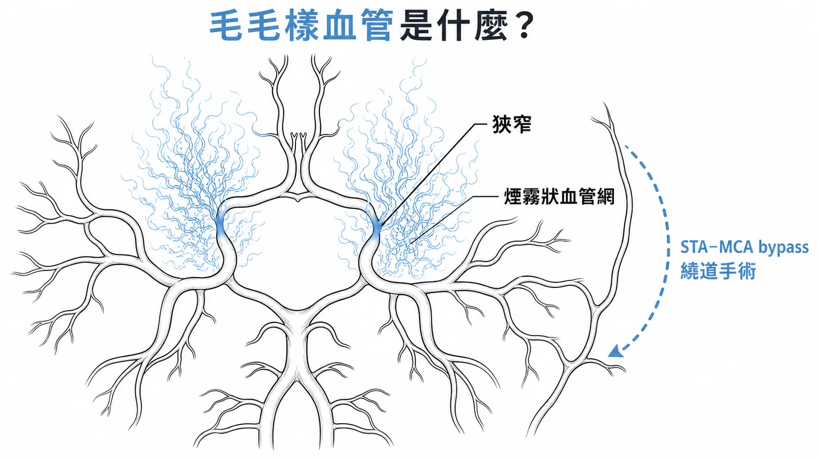 毛毛樣血管疾病：頸內動脈狹窄形成煙霧狀異常血管網，需STA-MCA bypass