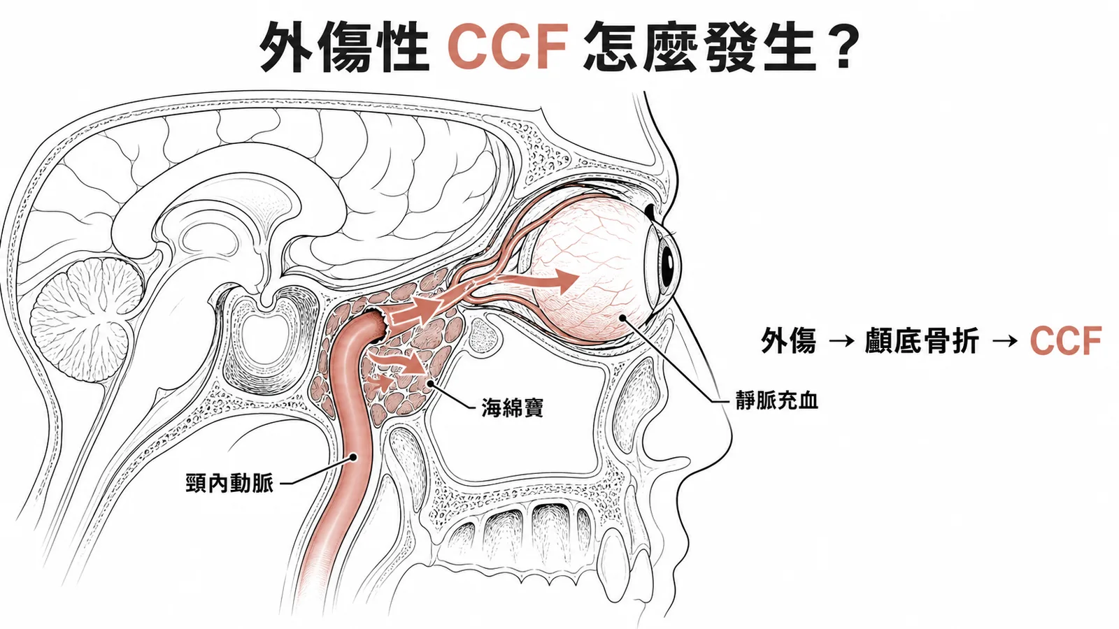 外傷性CCF:頸內動脈在海綿竇內破裂,動脈血異常流入靜脈系統