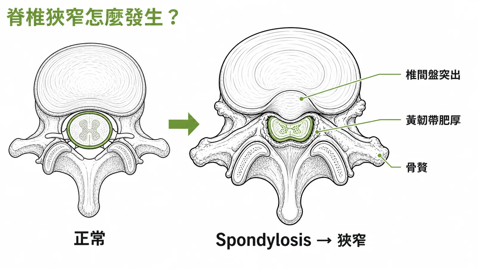脊椎狹窄成因:椎間盤突出、黃韌帶肥厚、骨贅三者夾擠脊髓
