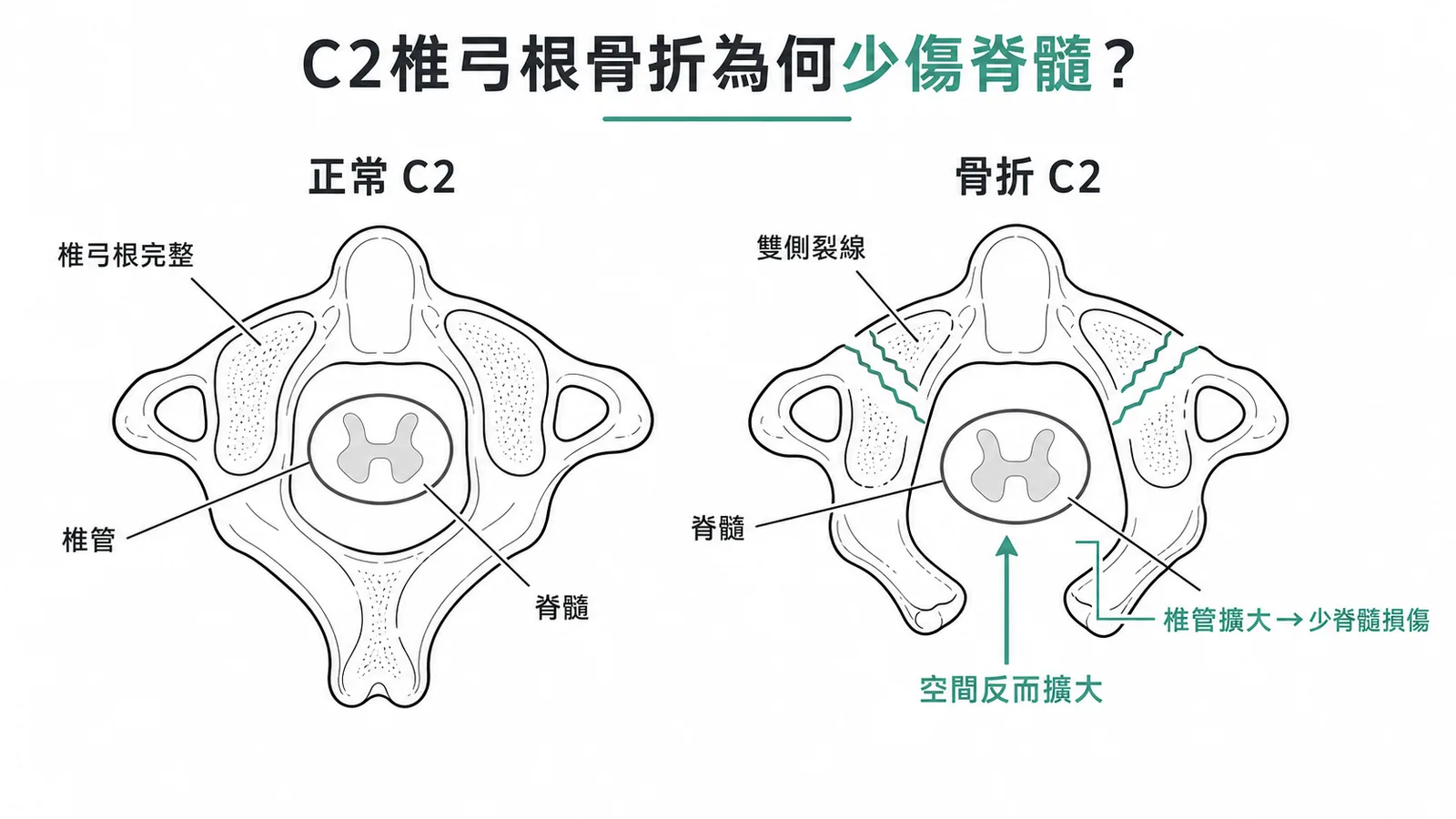 C2椎弓根骨折導致椎管擴大,反而少傷脊髓的機制示意圖