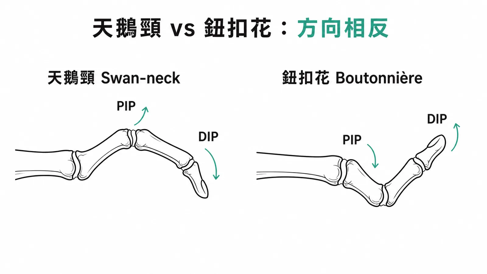天鵝頸與鈕扣花畸形的PIP和DIP關節方向相反示意圖