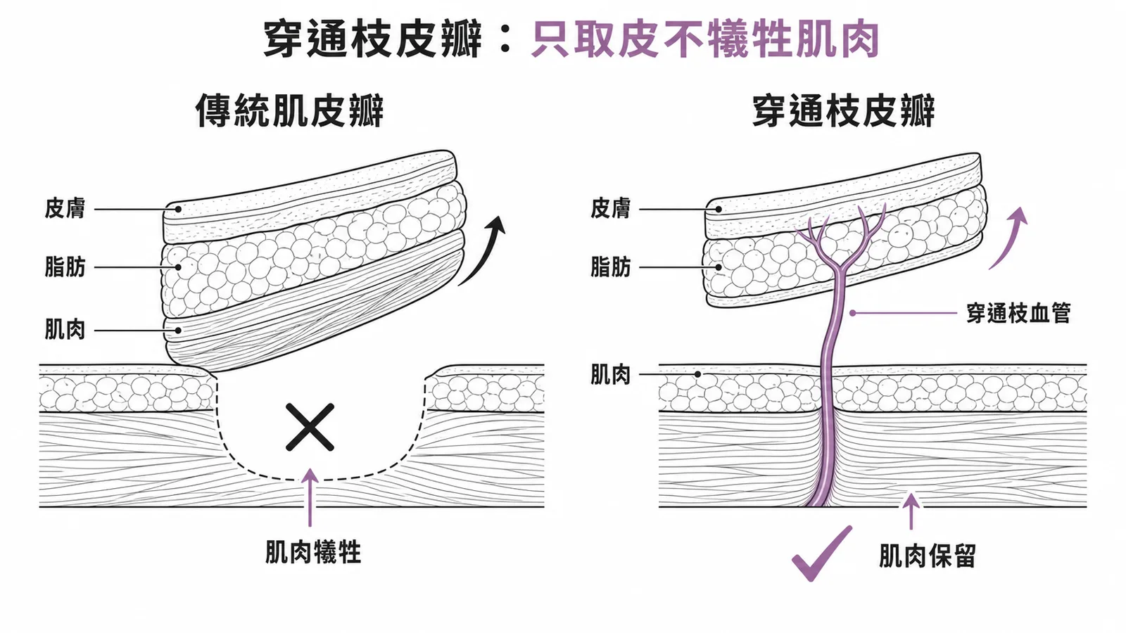 穿通枝皮瓣只取皮膚脂肪、保留肌肉的剖面對比示意圖