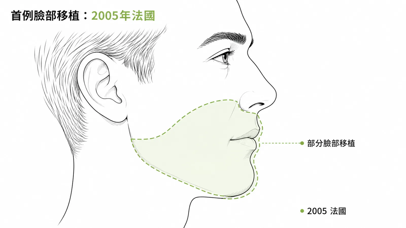 2005年法國完成全球首例部分臉部移植示意圖