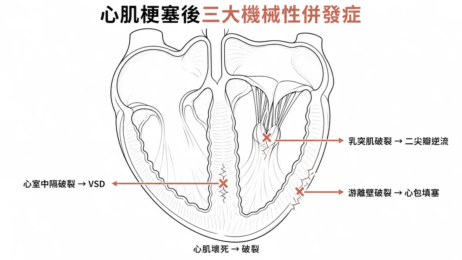 心肌梗塞後三大機械性併發症位置示意圖