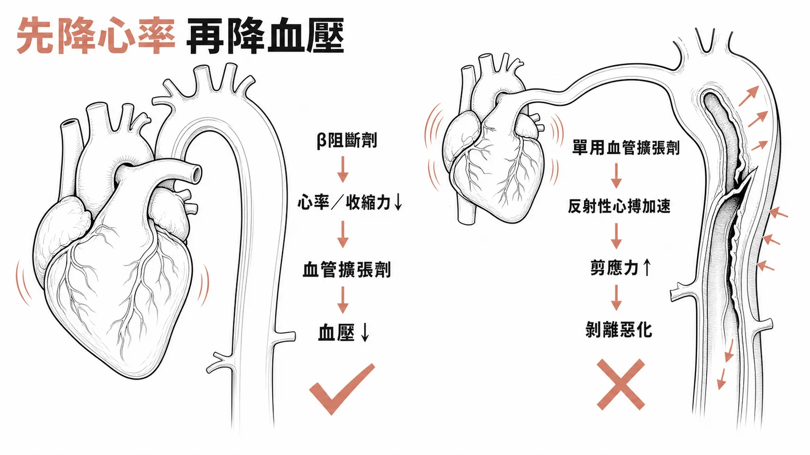 主動脈剝離血壓控制：先用β阻斷劑降心率再加血管擴張劑降血壓，單用擴張劑會反射性加速心搏使剝離惡化
