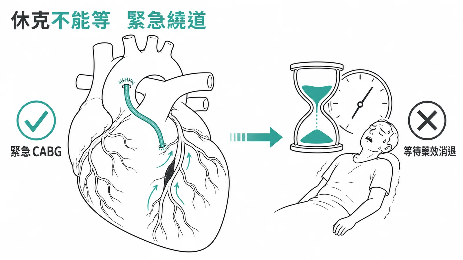 心因性休克多血管病變應緊急CABG繞道術，不可等待抗血小板藥效消退延誤救治