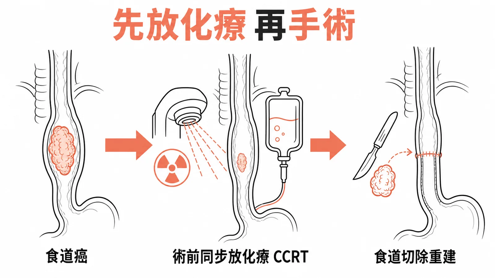 局部晚期食道癌治療流程：先術前同步放化療CCRT縮小腫瘤，再行食道切除重建手術