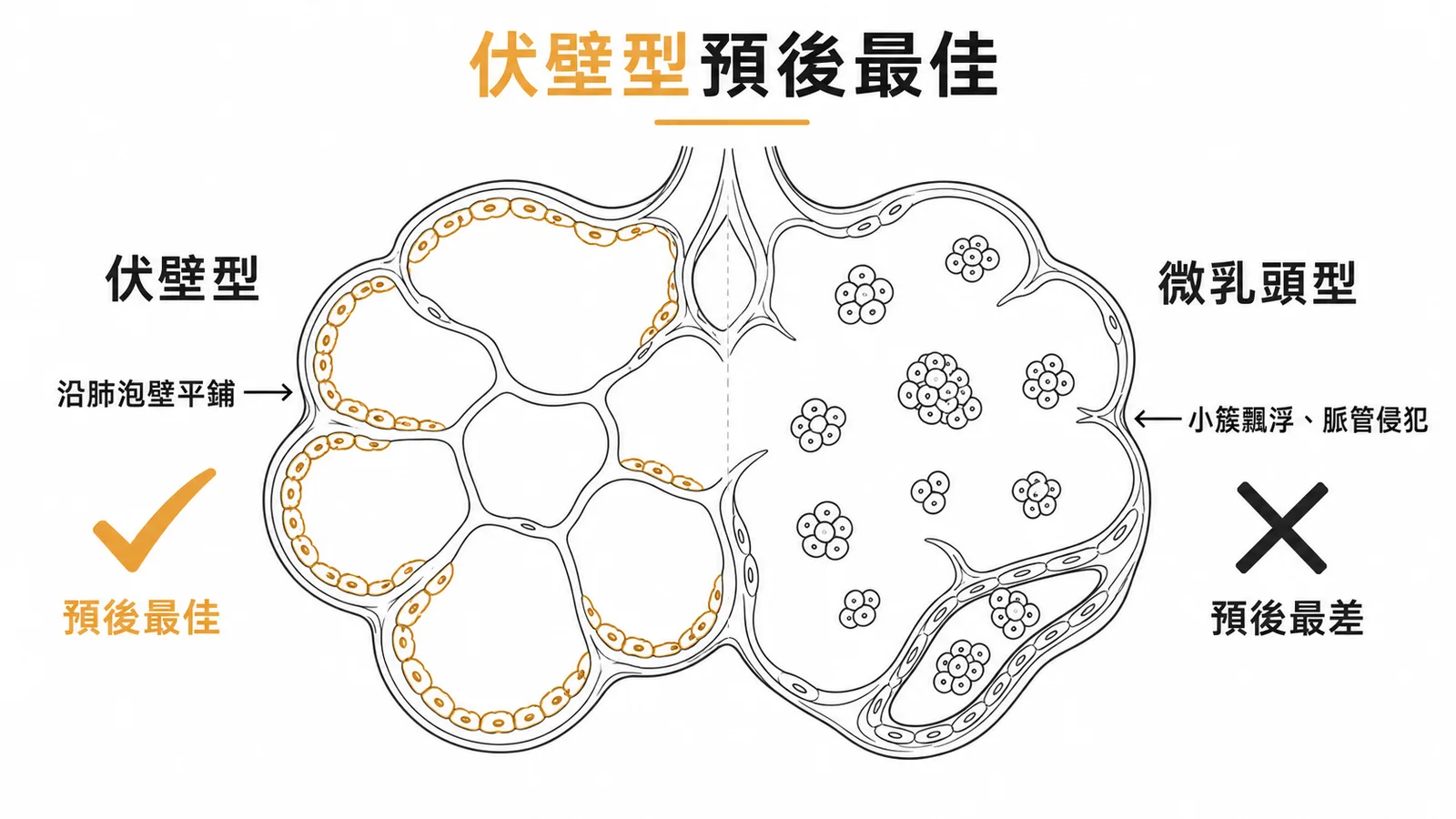 肺腺癌亞型預後對照：伏壁型沿肺泡壁平鋪生長預後最佳，微乳頭型小簇飄浮侵犯脈管預後最差