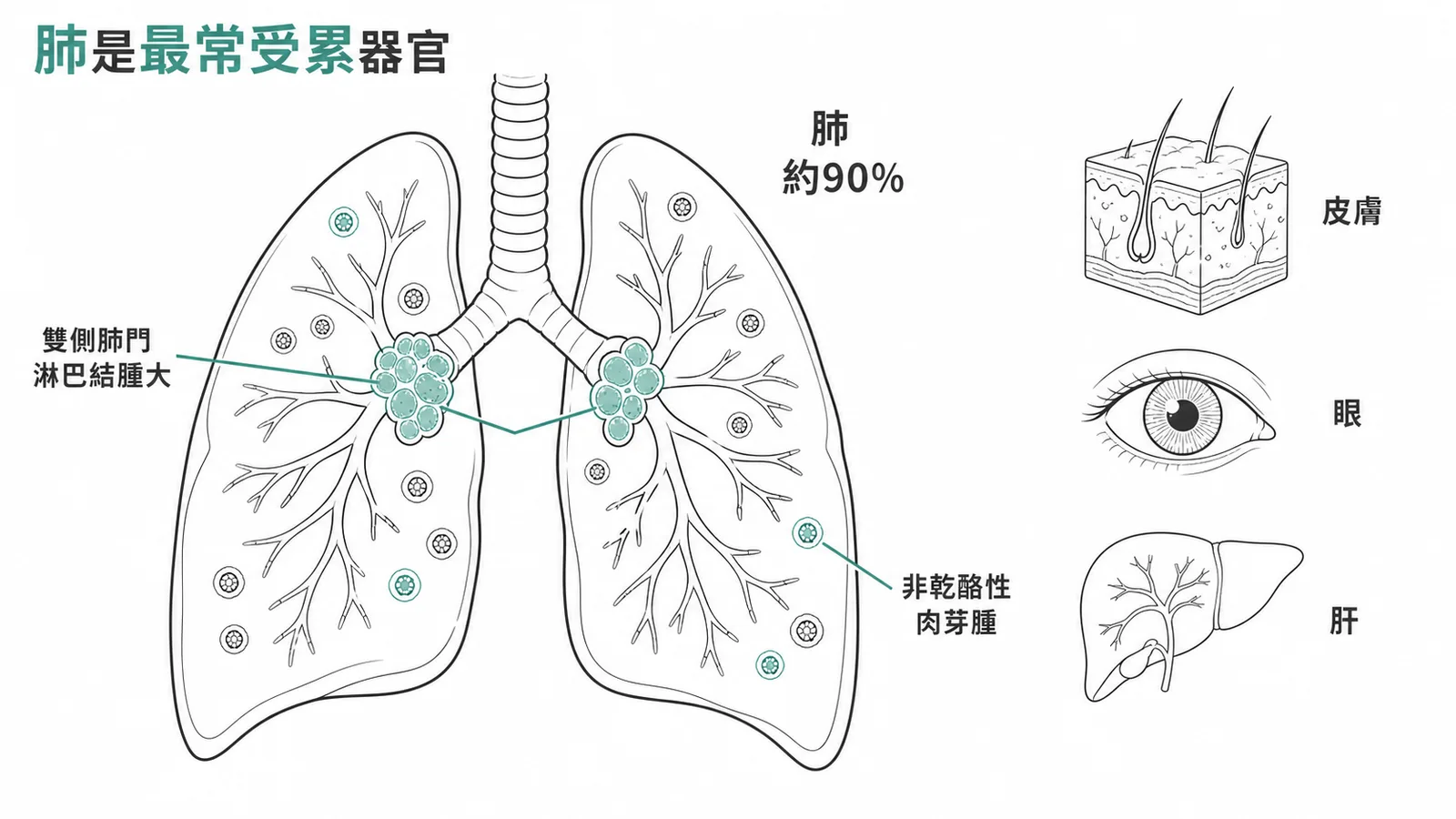 類肉瘤病以肺為最常受累器官約九成，雙側肺門淋巴結腫大與非乾酪性肉芽腫為特徵，亦可侵犯皮膚眼肝等全身器官