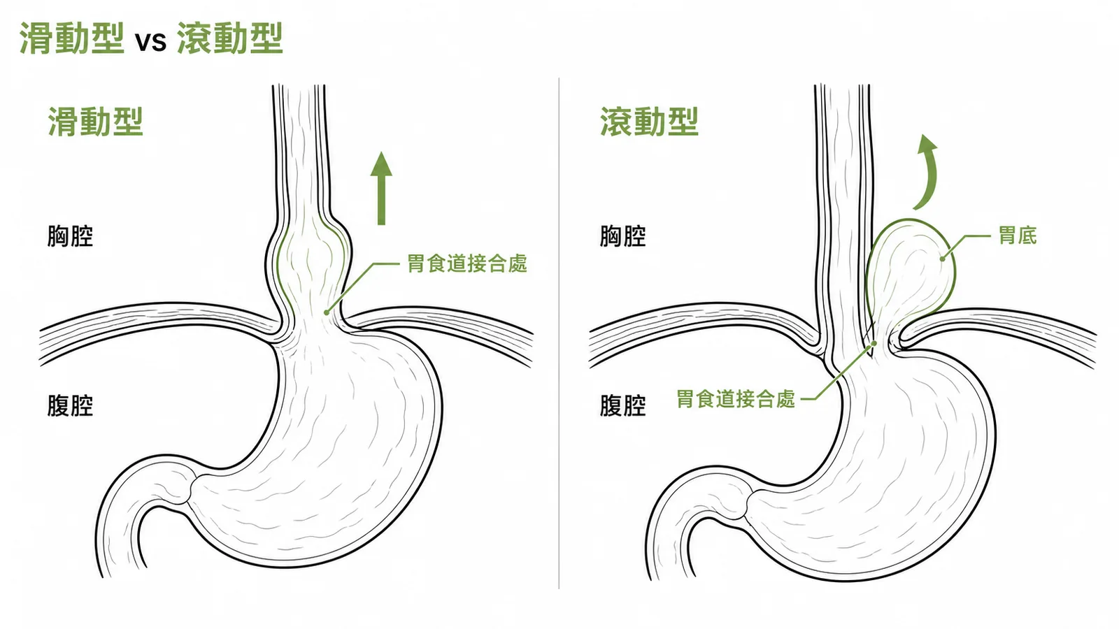 食道裂孔疝氣分型對照：Type I滑動型GEJ上移入胸腔，Type II滾動型GEJ留原位但胃底滾入食道旁