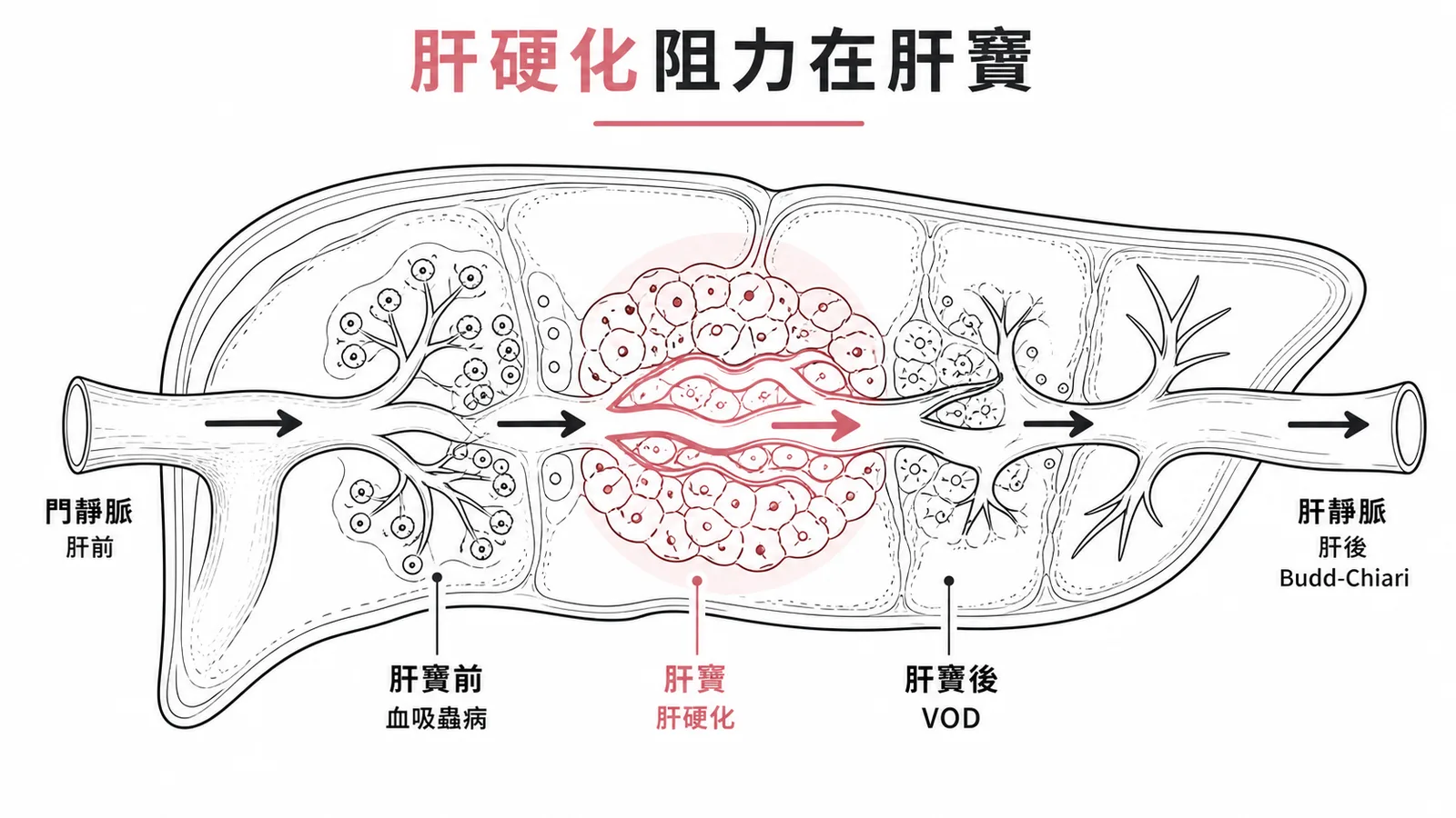 門靜脈高壓阻力位置分類：肝前門靜脈→肝竇前血吸蟲病→肝竇肝硬化→肝竇後VOD→肝後Budd-Chiari，肝硬化阻力在肝竇