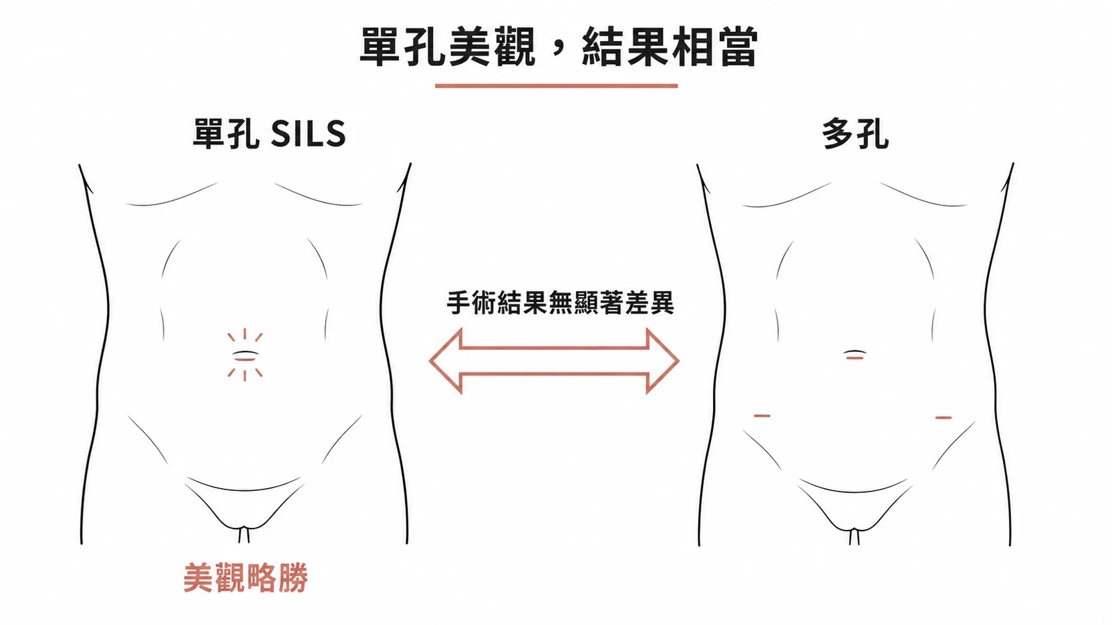 單孔與多孔腹腔鏡闌尾切除術的手術結果比較