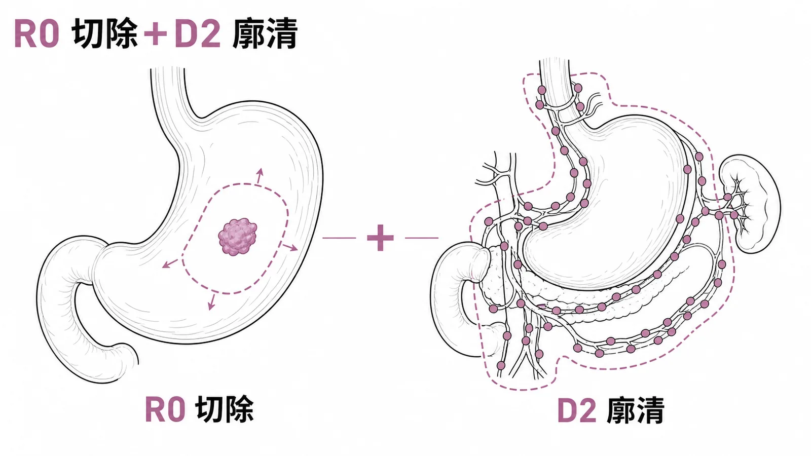 胃癌手術R0切除與D2淋巴結廓清示意圖