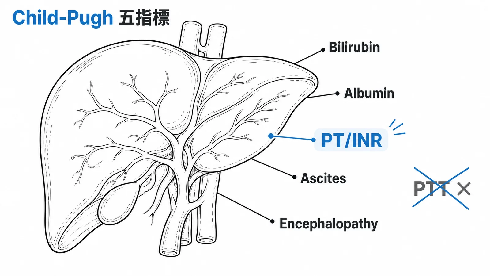 Child-Pugh分級五指標與PT/INR凝血指標