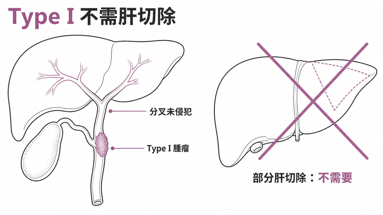 Bismuth-Corlette Type I膽管癌不需部分肝切除
