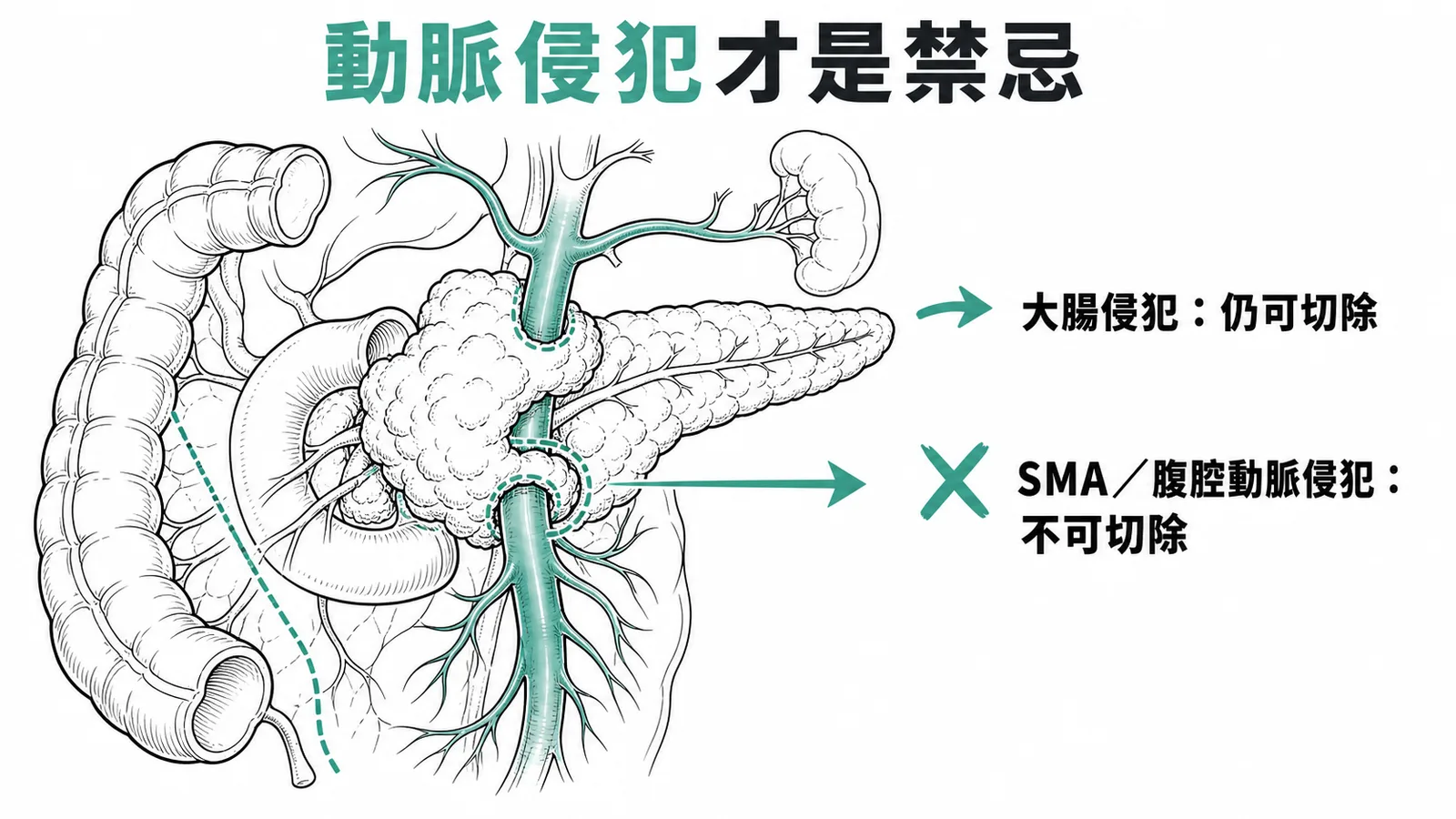 胰臟癌動脈侵犯才是根除性切除禁忌