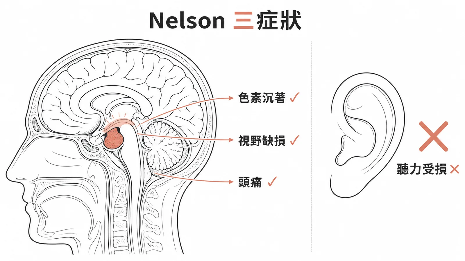 Nelson症候群三大症狀與聽力受損無關