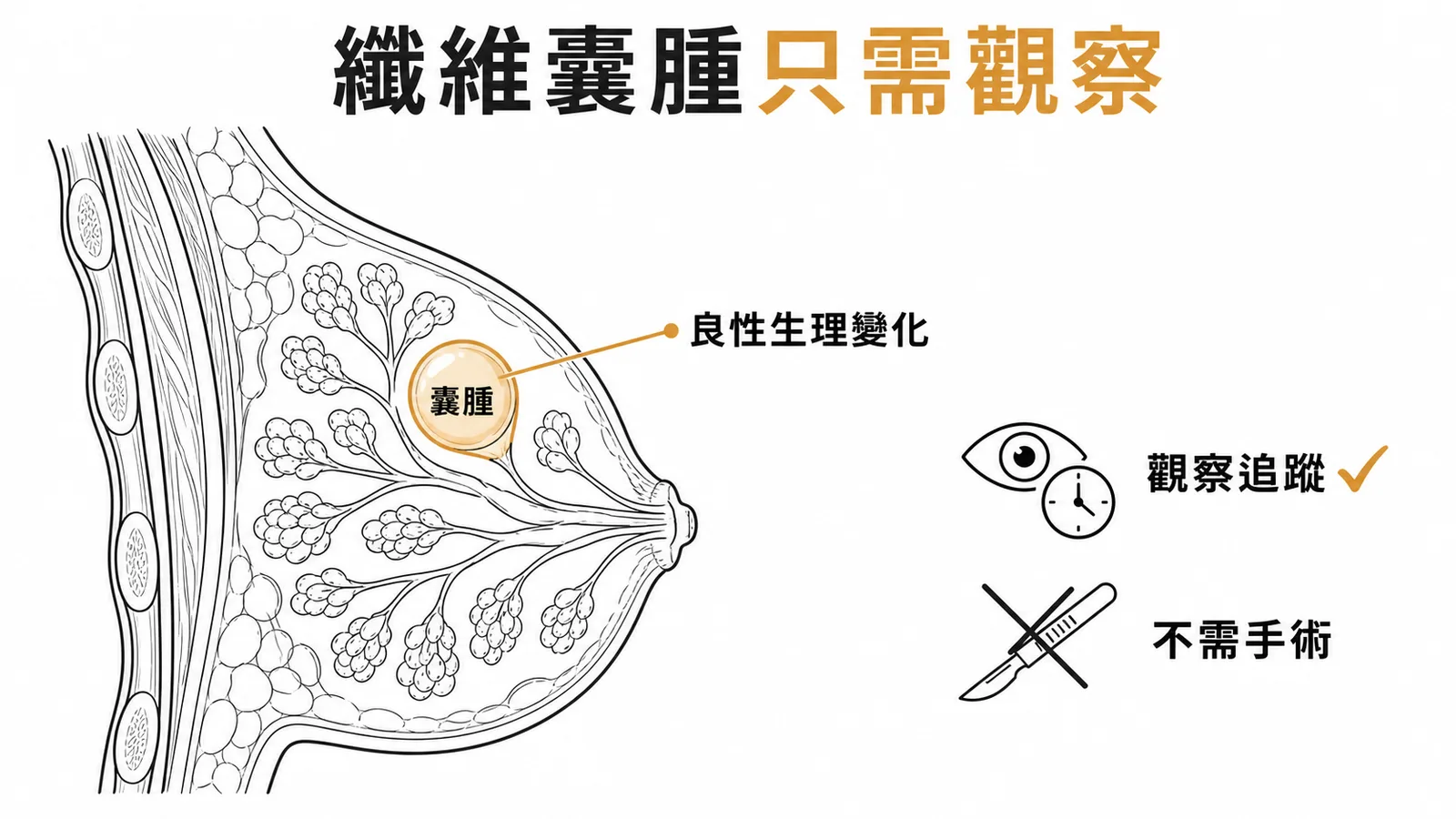 乳房纖維囊腫為良性只需觀察追蹤
