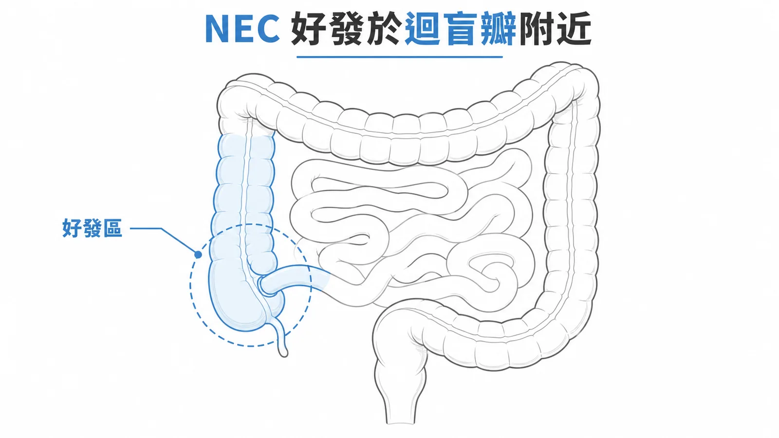 NEC好發於迴盲瓣附近的腸道示意圖