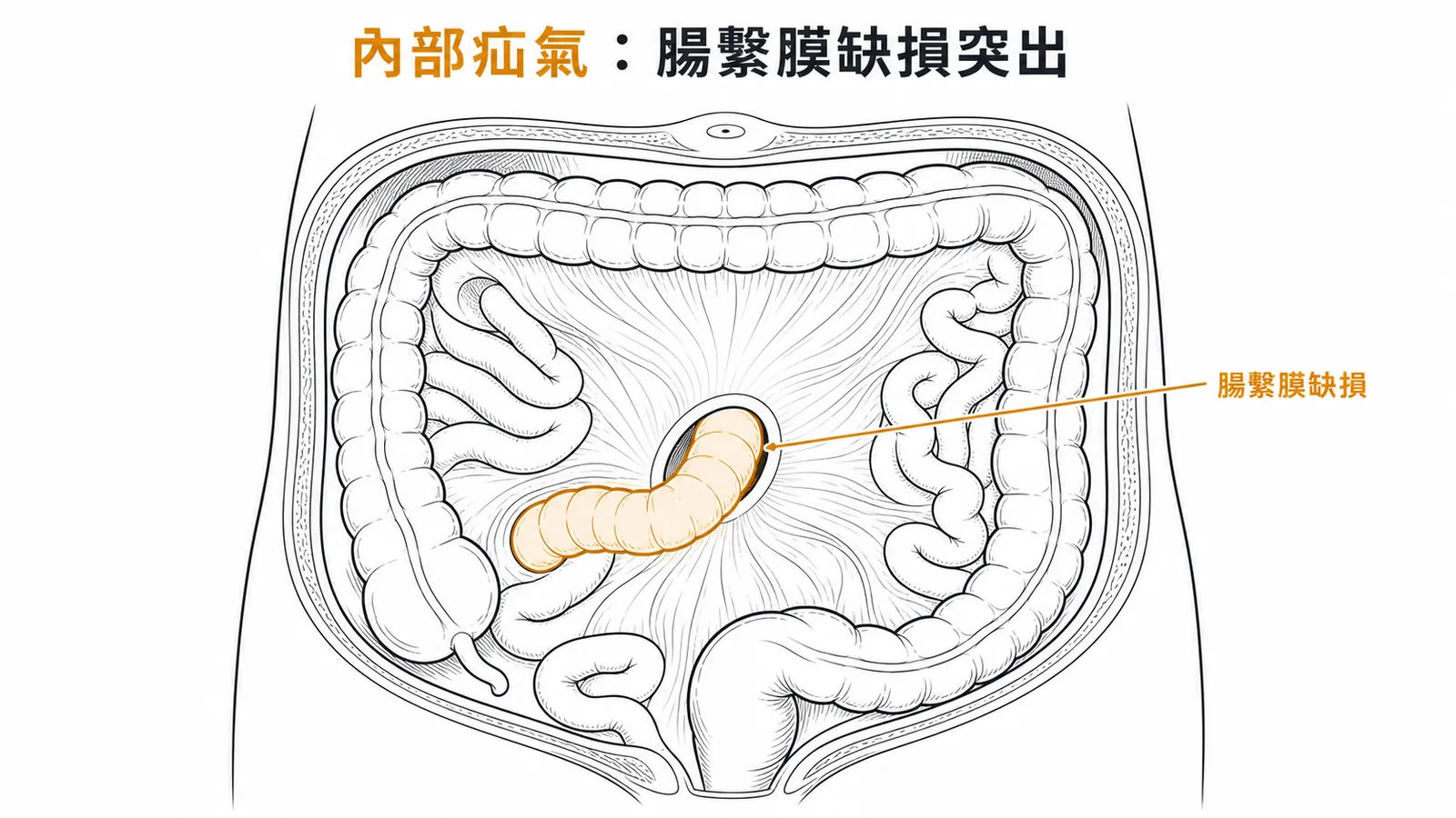 內部疝氣腸道經腸繫膜缺損突出的示意圖