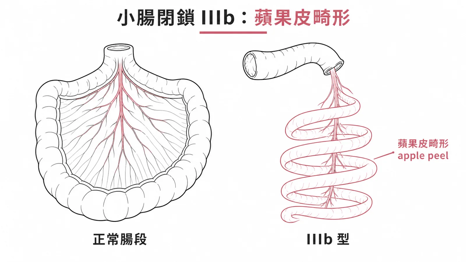小腸閉鎖IIIb型蘋果皮畸形與正常腸段對照
