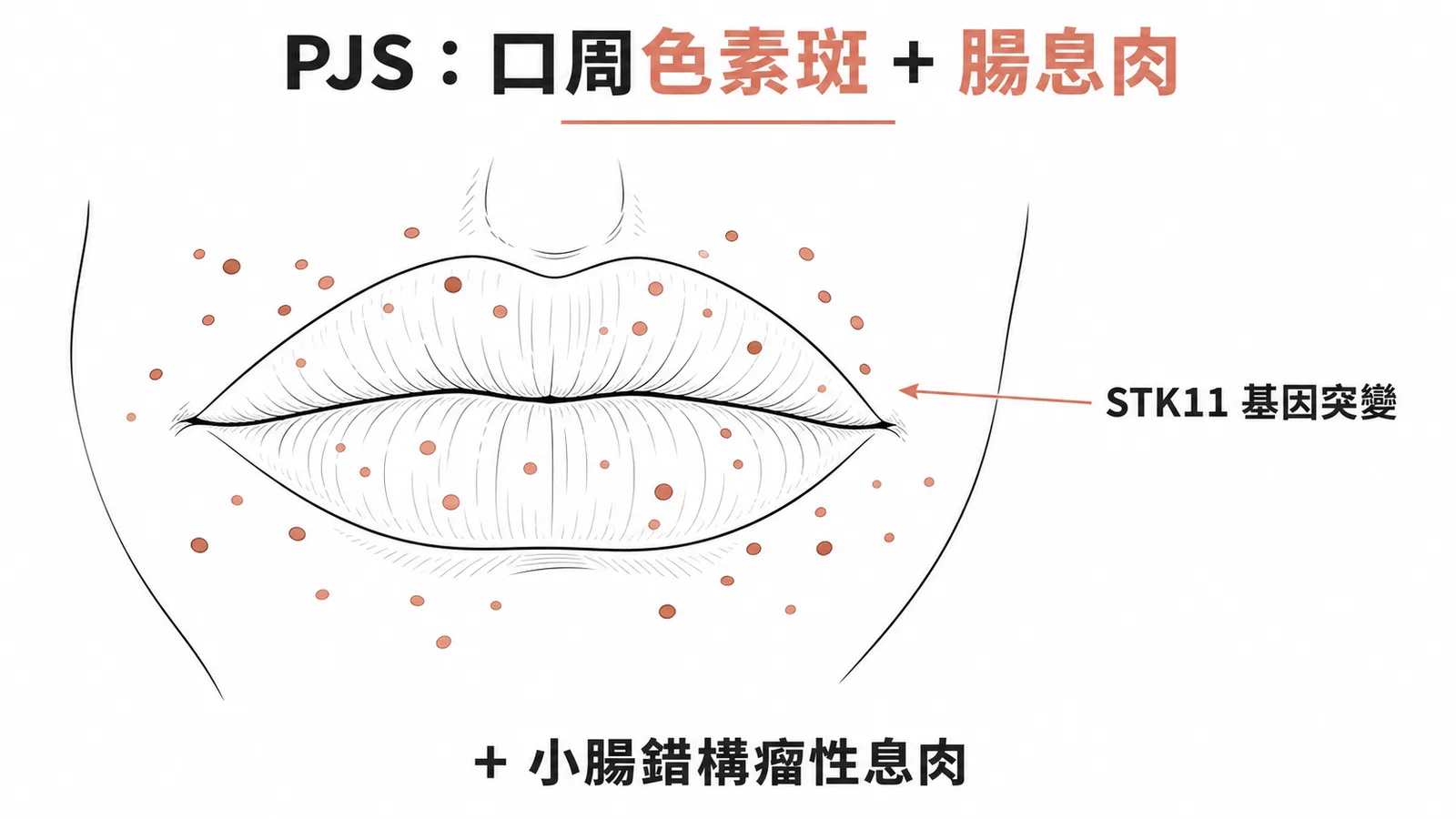 PJS口周色素斑與STK11基因突變示意圖