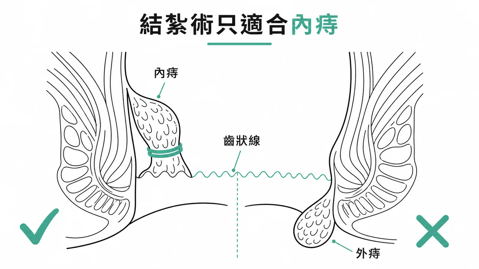 痔瘡結紮術只適合齒狀線以上的內痔，外痔有痛覺神經不適合結紮
