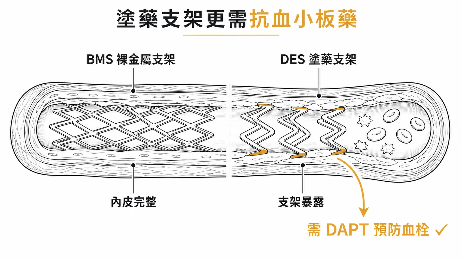 塗藥支架（DES）延遲內皮化，支架暴露於血液中，必須長期服用 DAPT 預防血栓