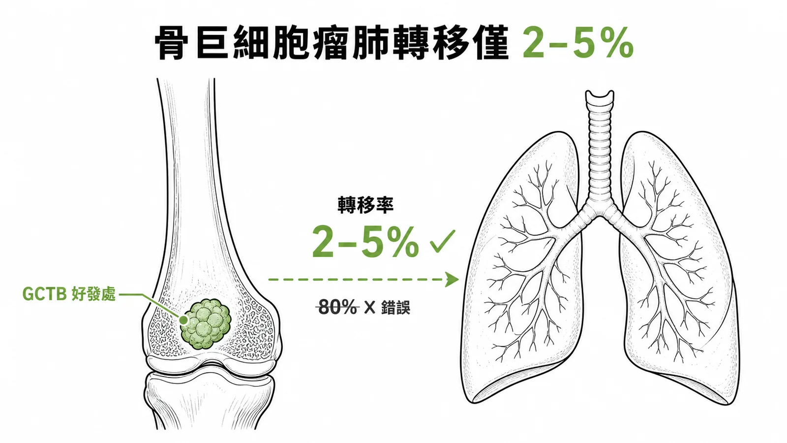 骨巨大細胞瘤好發於長骨骨骺端,肺轉移率僅約 2-5%,非 80%