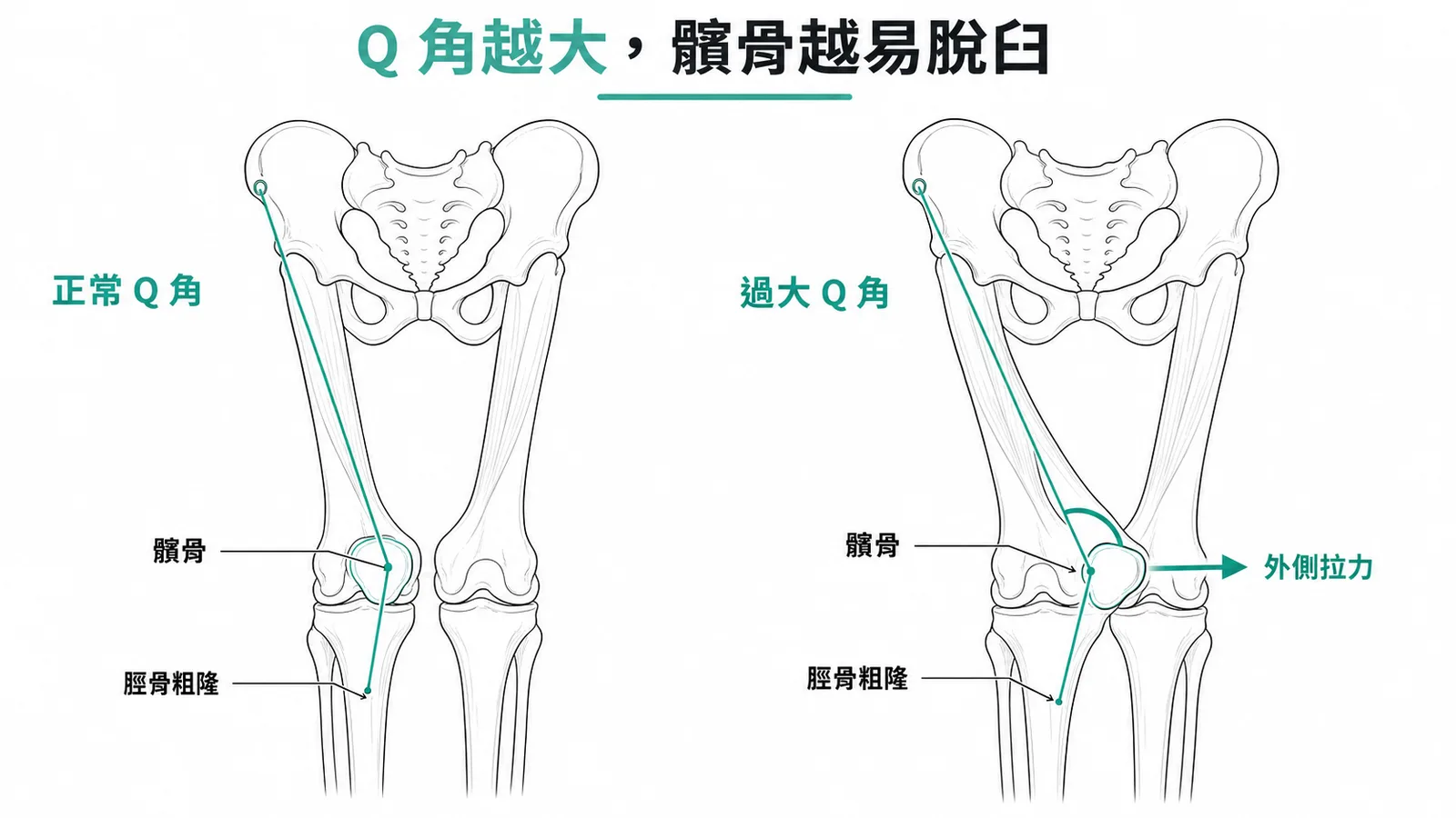 Q 角度越大,股四頭肌對髕骨的外側拉力越大,髕骨越容易脫臼