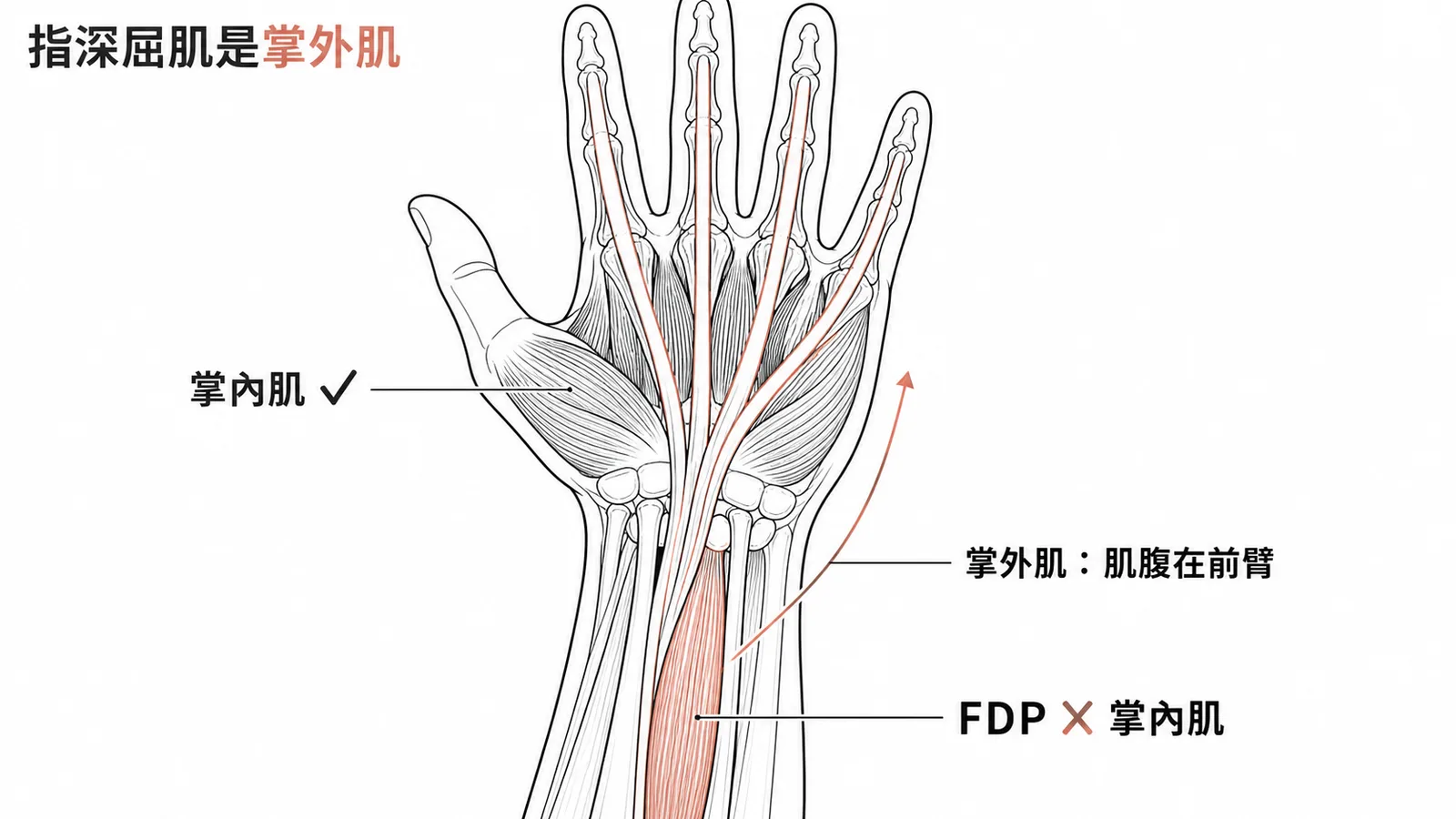 指深屈肌（FDP）肌腹在前臂，屬掌外肌群，非掌內肌
