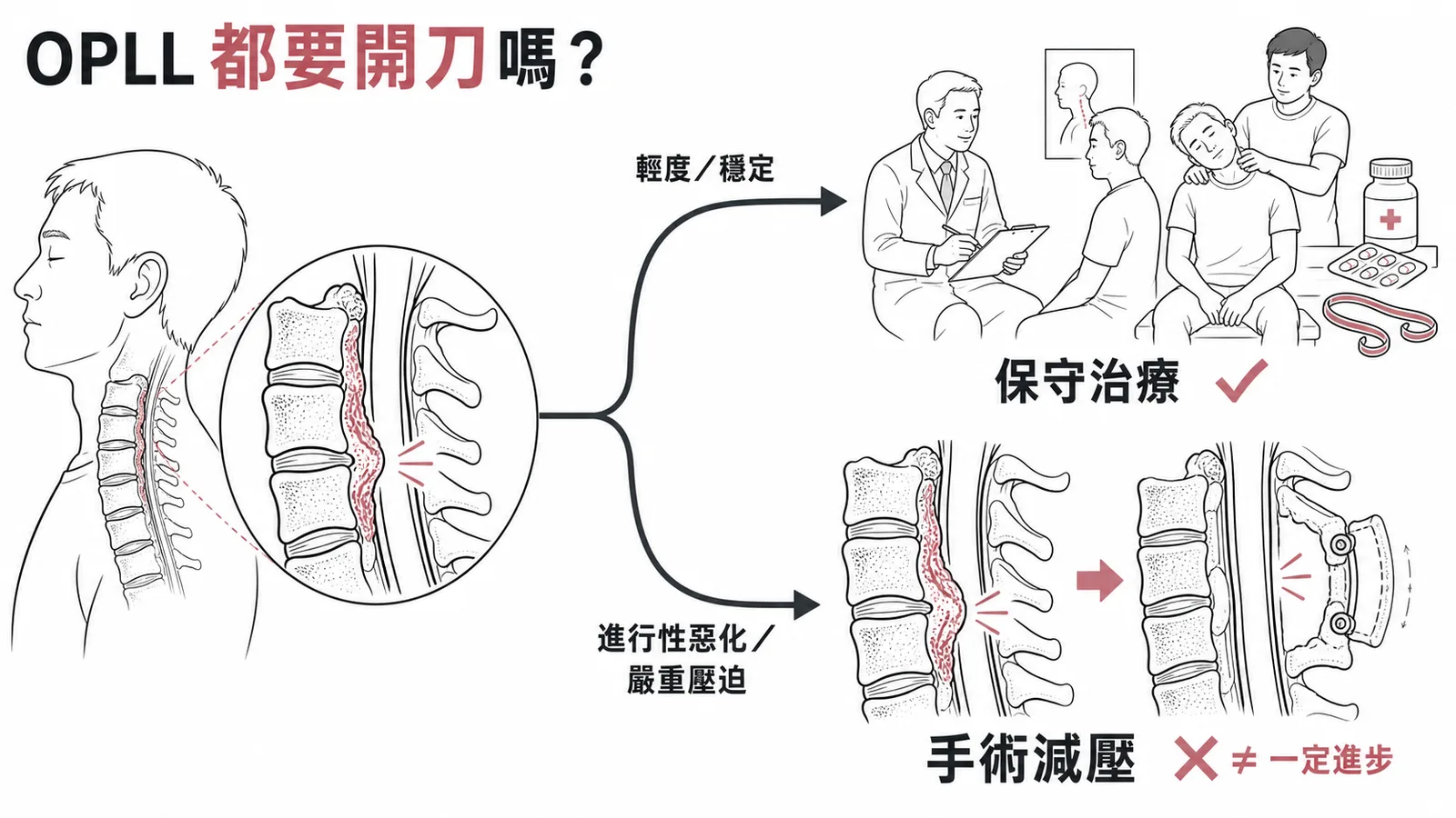 OPLL治療決策分流:輕度穩定首選保守治療,手術不保證進步