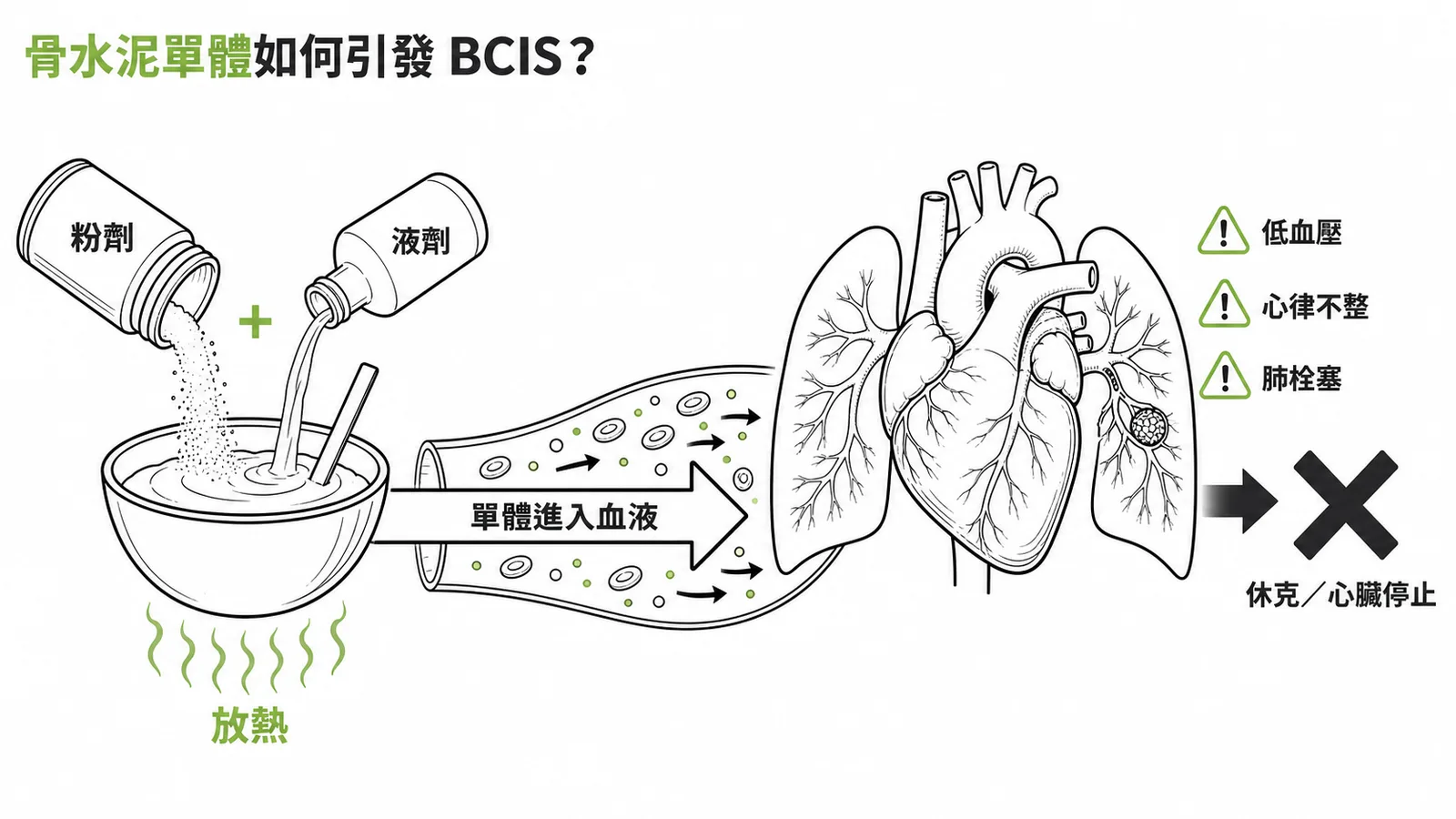 骨水泥單體進入血液引發BCIS的機轉示意