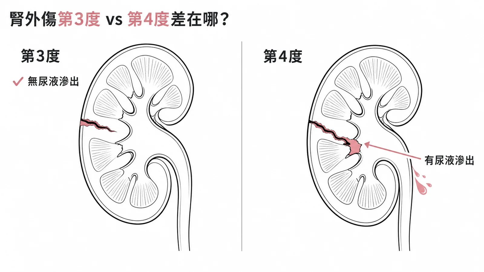 腎外傷第3度vs第4度差異：有無尿液滲出