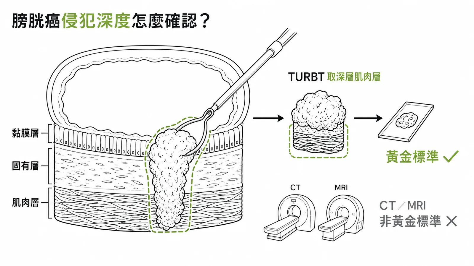 膀胱癌侵犯深度診斷：TURBT取肌肉層切片為黃金標準