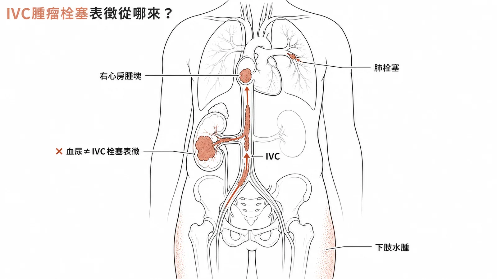 IVC腫瘤栓塞表徵來自靜脈回流受阻而非腎出血