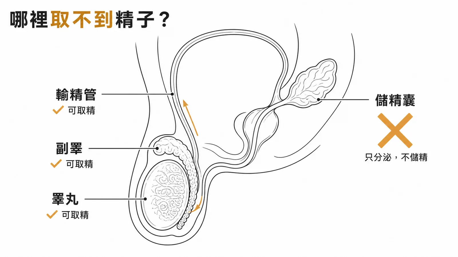 精子路徑：睪丸副睪輸精管可取精，儲精囊只分泌不儲精