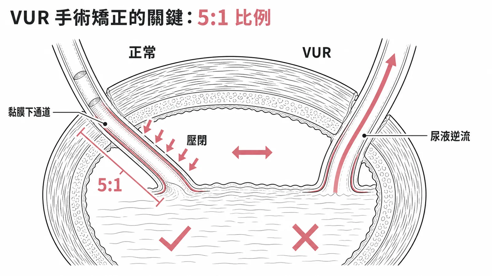 VUR手術矯正關鍵：黏膜下通道長度與輸尿管直徑5比1