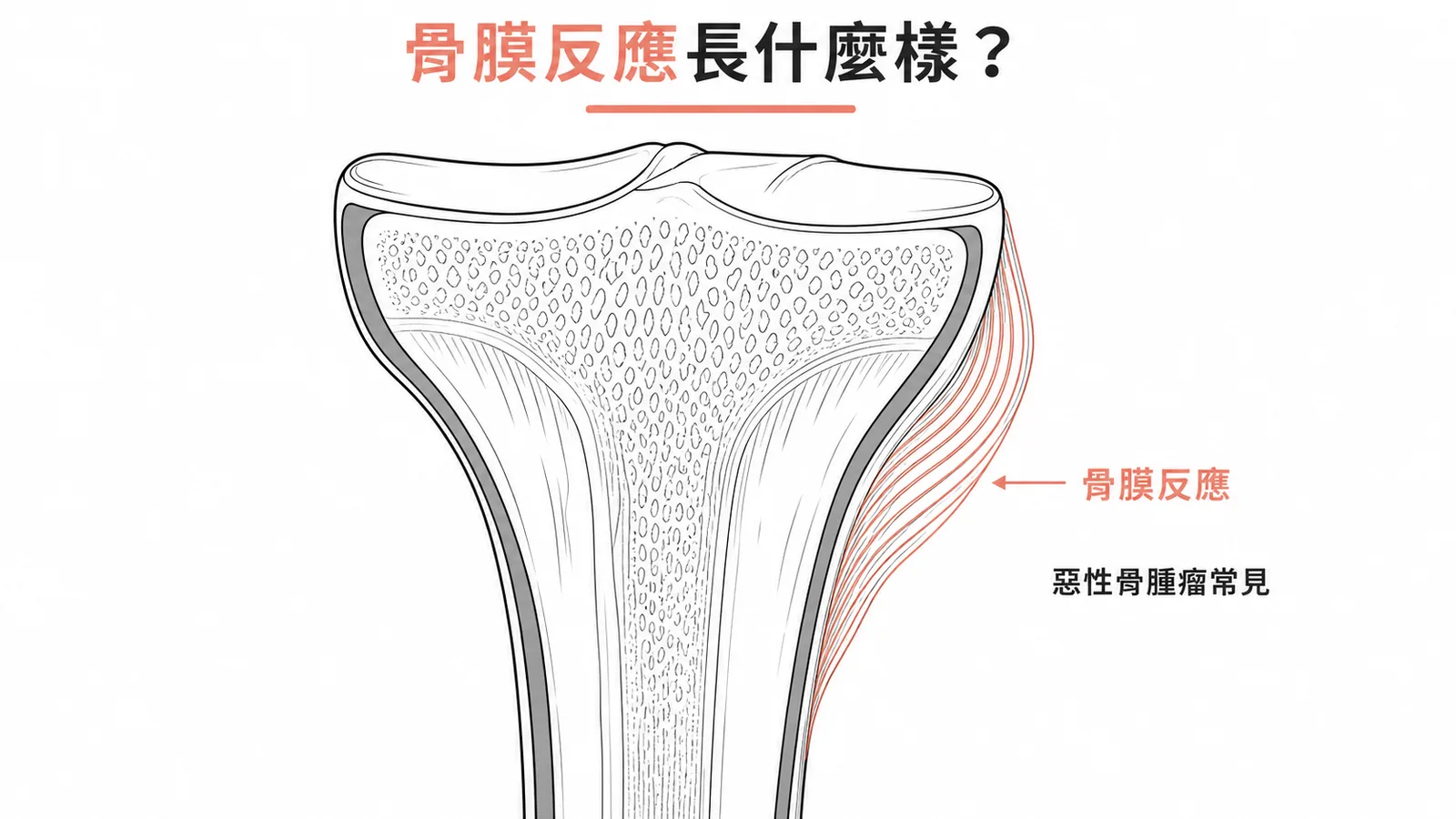 骨肉瘤骨膜反應的洋蔥皮樣分層示意圖