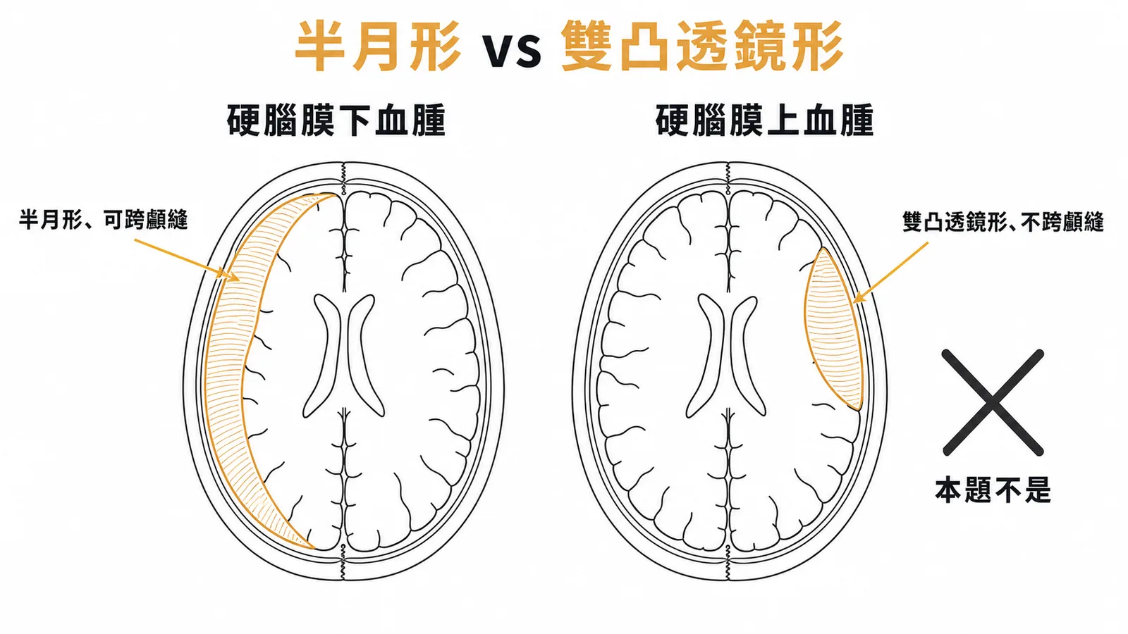 硬腦膜下血腫半月形與硬腦膜上血腫雙凸透鏡形對照示意圖