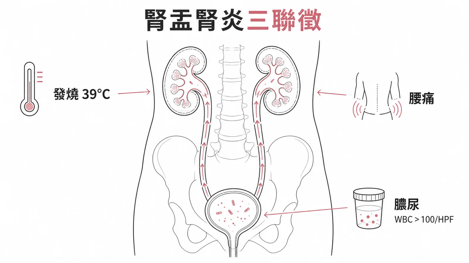 腎盂腎炎三聯徵：發燒、腰痛、膿尿示意圖