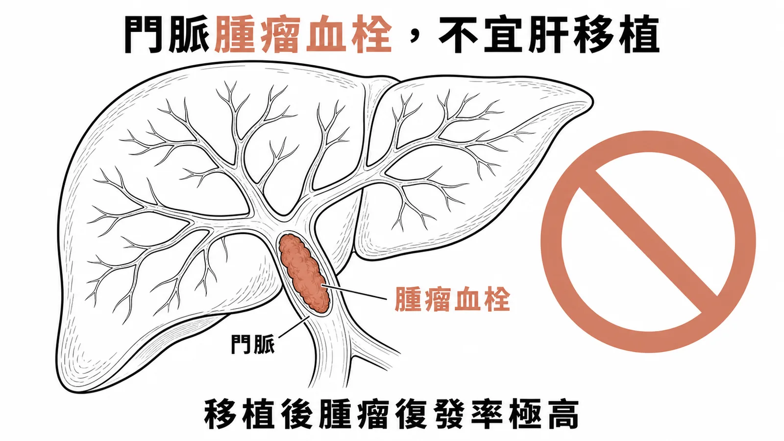 門脈腫瘤血栓是肝臟移植的禁忌症,移植後腫瘤復發率極高