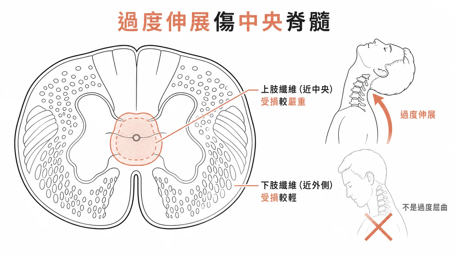 中央脊髓症候群的脊髓橫切面與過度伸展機轉示意圖